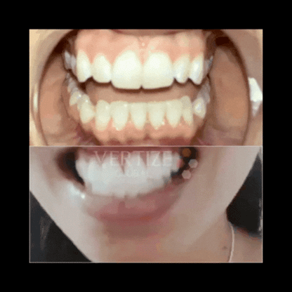 Blanqueador Dental Ultra™ by Vertize Global